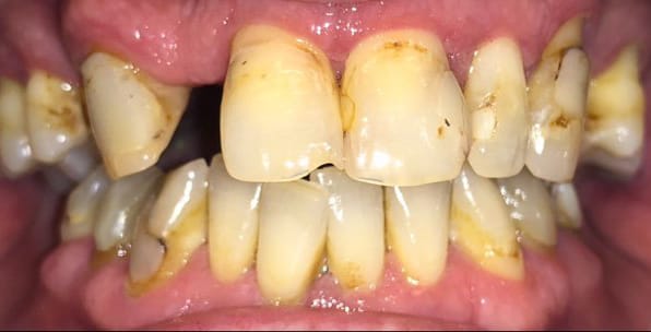 Bright Smiles Marble Falls Case 1 before