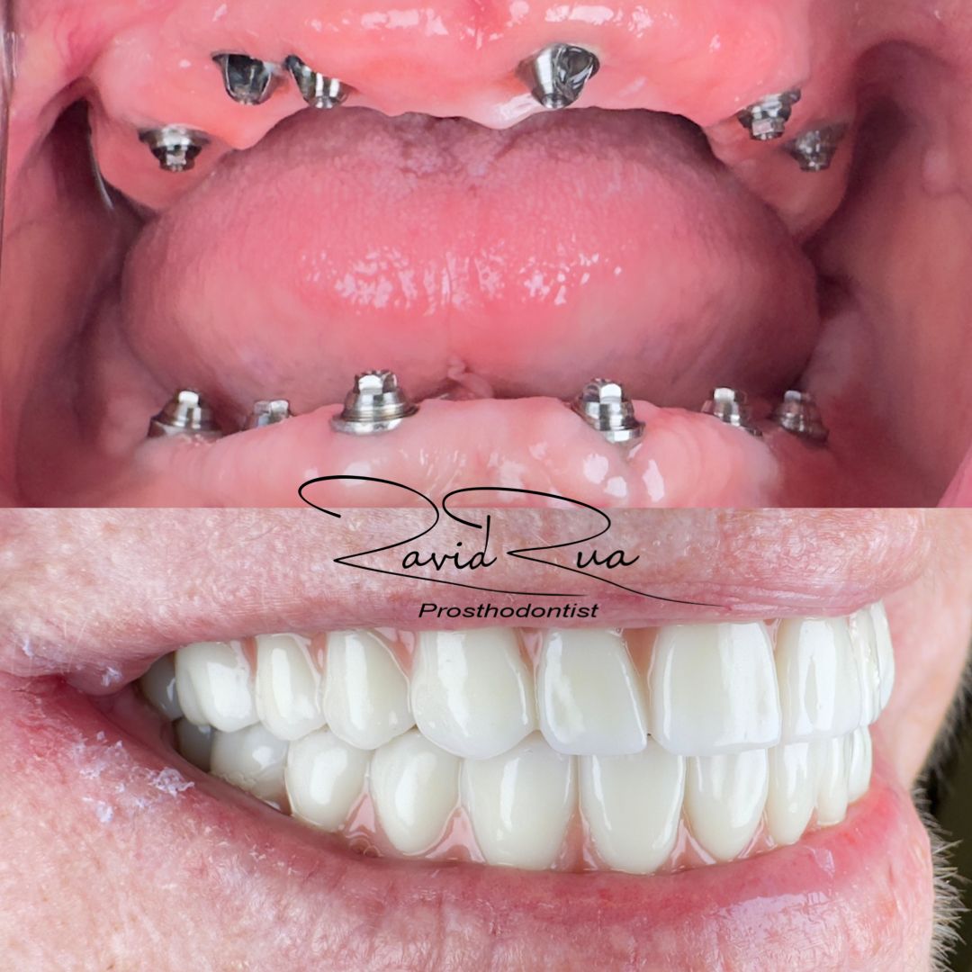 TC Cape Coral Case 1.1 All on 6 Implant hybrids