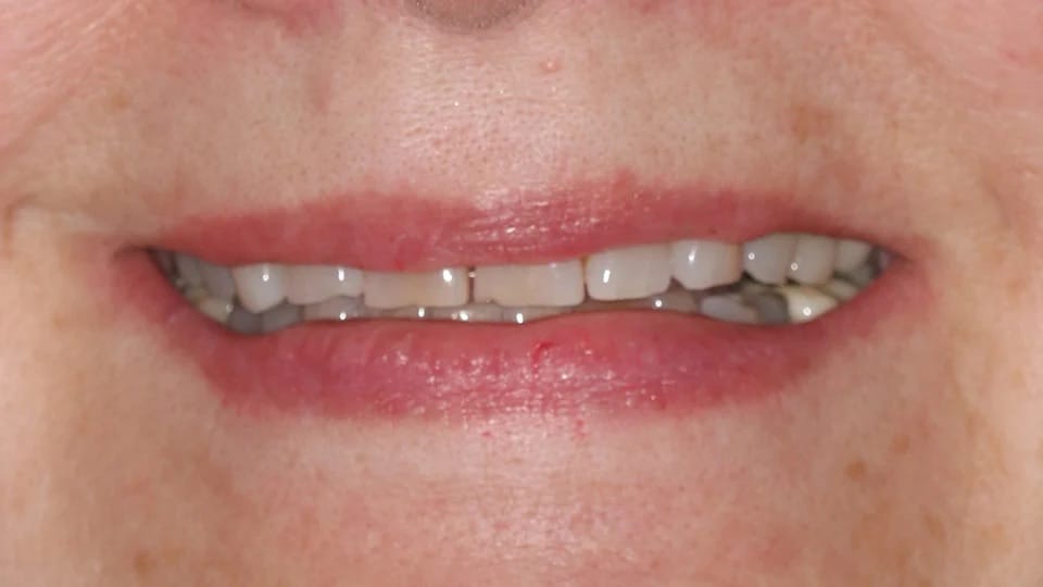 Anastasia Smile 07 before image
