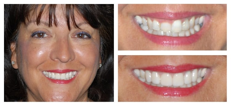Before and After Smile Gallery