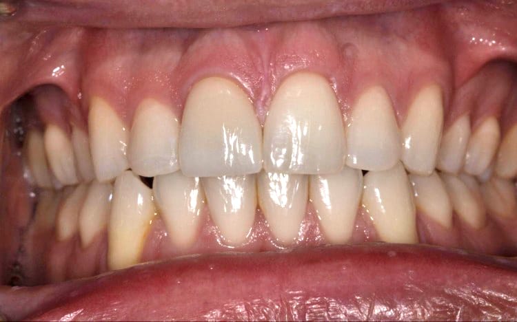 Patient JP (1 tooth): Single front tooth porcelain crown after
