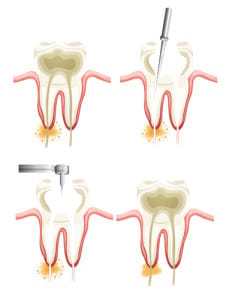 Root Canal