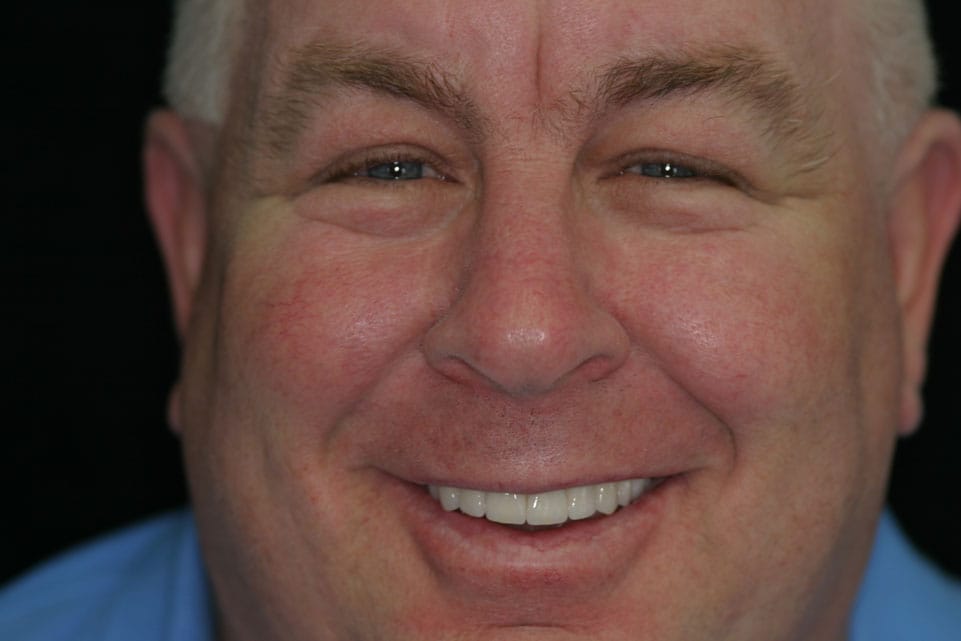 Rasner Smile gallery after 13