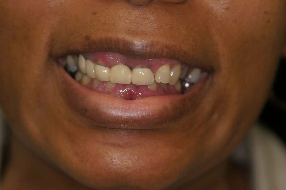 Rasner Smile gallery before 20