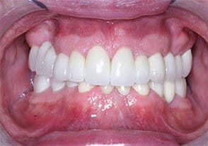 ballston smile gallery case-8-after