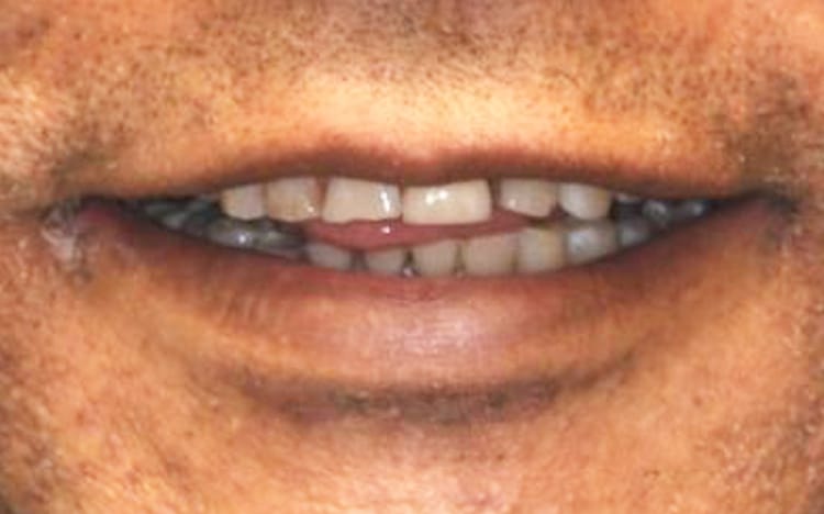28 (1). Patient GD (26 teeth + 2 implants - one implant is a front tooth!)_ 13 upper teeth with one front tooth porcelain implant crown and 13 lower porcelain crowns Before