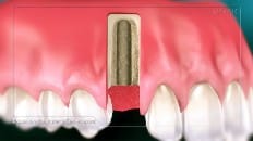 Single Implant (Anterior - Immediate Load) 002