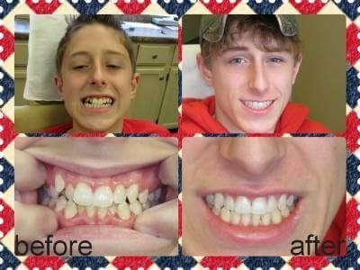 Before and After