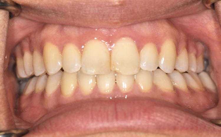 4 (1). Patient HM (2 teeth)_ 2 porcelain veneers on front teeth Before