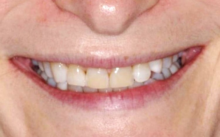6. Patient SF (4 teeth)_ 4 porcelain veneers on front teeth Before