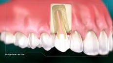 Root Canal image 004