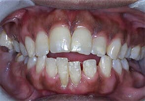ballston smile gallery case-7-before
