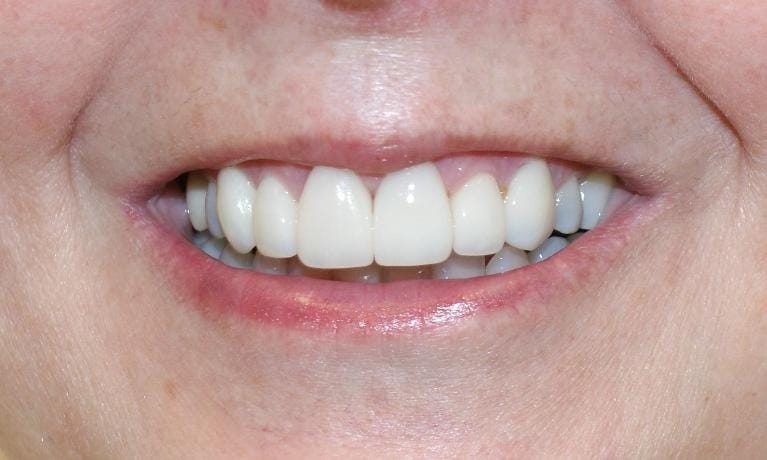 Grapevine After Veneers 1