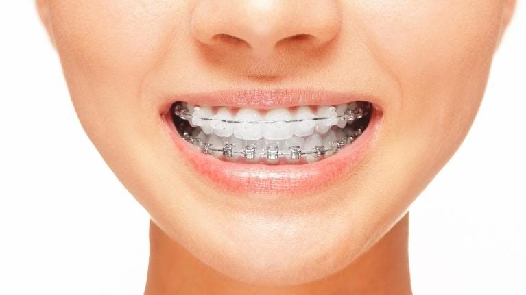 DIY Braces DIY Braces