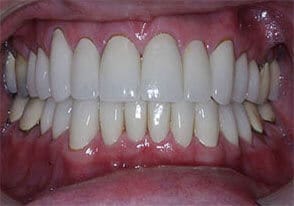 ballston smile gallery case-14-after