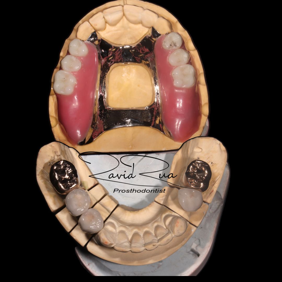 TC Cape Coral Case 19.1 Full mouth rehab, Implants , crowns and partial