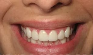 Veneers after