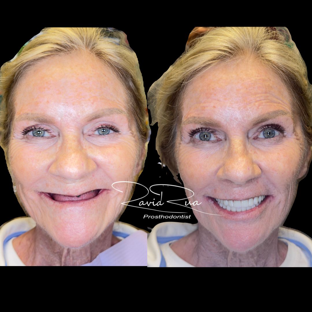 TD Cape Coral case 1 All on 6 implant hybrids