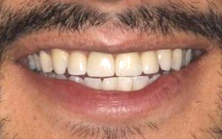 8. Patient J.D_ 2 porcelain crowns for smaller peg lateral teeth, implant front tooth with custom tissue shaping and porcelain implant crown, and front tooth porcelain veneer After