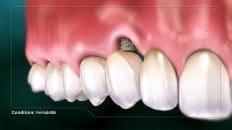 Peri-Implantitis 002
