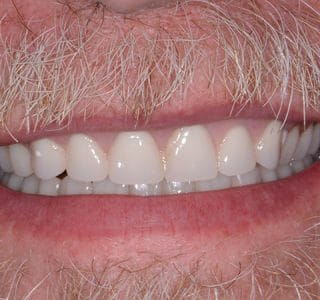 Dentures After