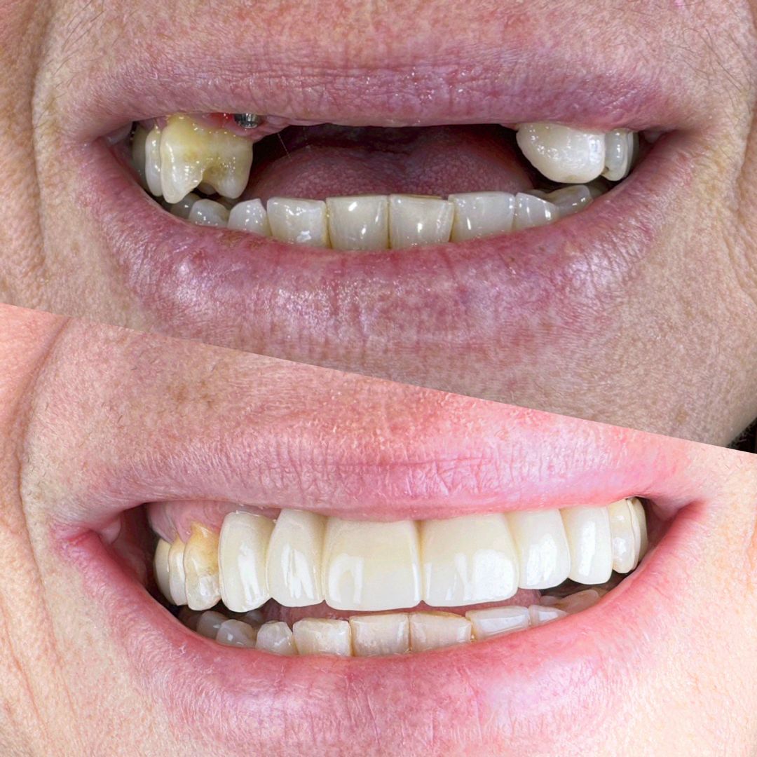 TC Cape Coral Case 24 Top anterior implant bridge