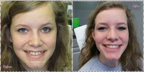 Before and after