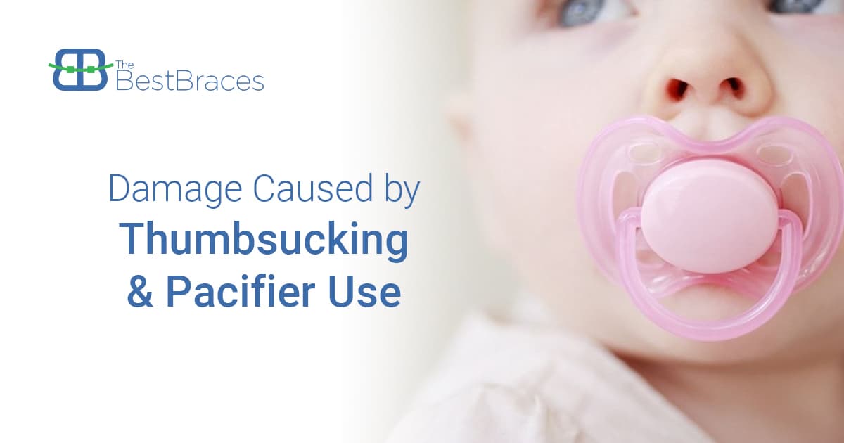 Damage Caused by Thumbsucking and Pacifier Use Damage Caused by Thumbsucking and Pacifier Use