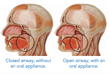 Sleep apnea issues
