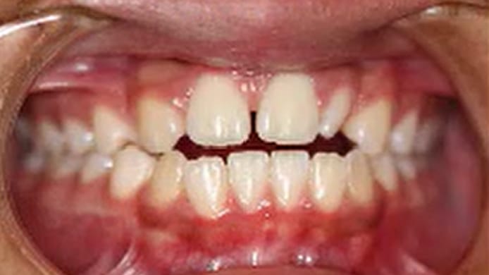 BF Ortho Smile Gallery Before