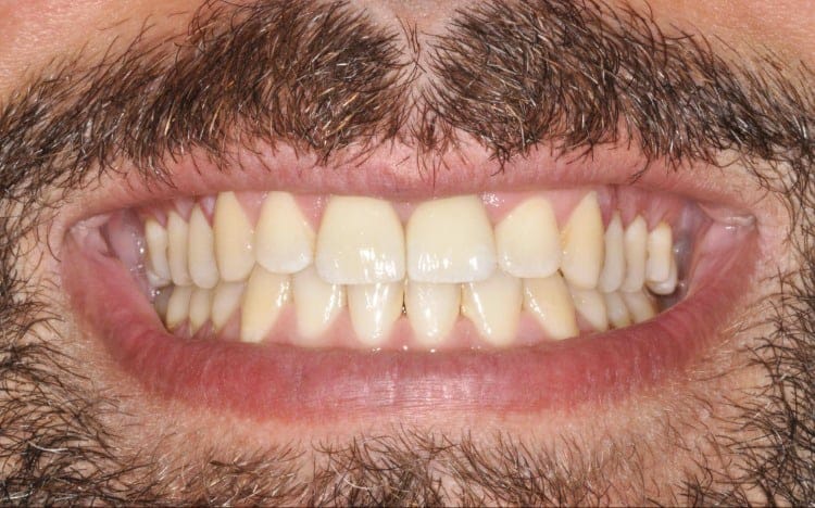 5 (1). Patient KT_ One front tooth porcelain veneer and an adjacent implant with custom tissue shaping and porcelain implant crown After