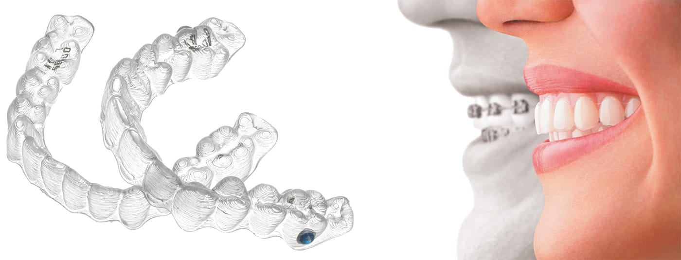 Illustration of Invisalign
