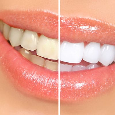 teeth whitening