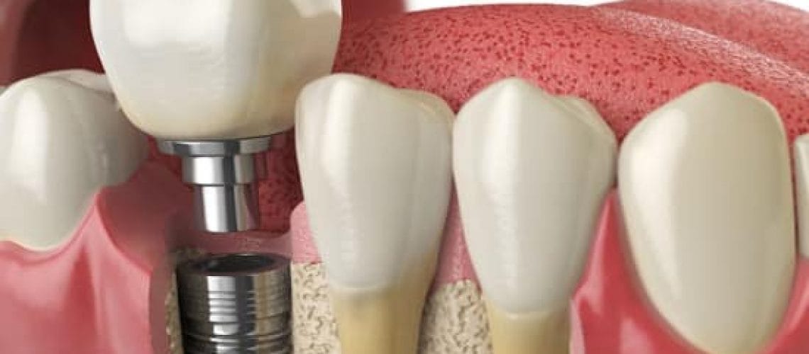 Alsbury Dental Implants Candidate Alsbury Dental Implants Candidate