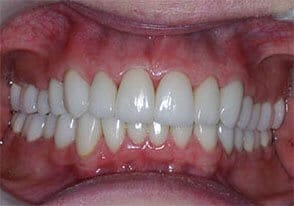 ballston smile gallery case-11-after