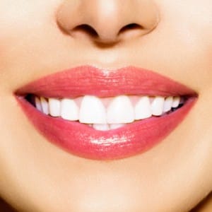 Veneer