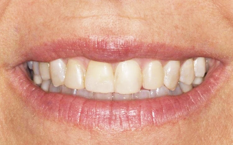 7 (1). Patient MB (4 teeth)_ 4 porcelain veneers on front teeth Before