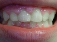 Gum Lengthening before