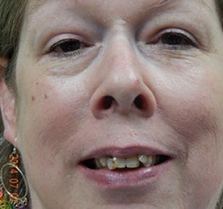 Dental Implants Before