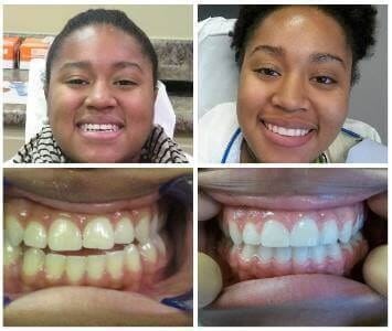 Before and after