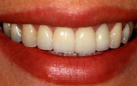 Smile Gallery - after