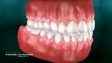 Screw-Retained Implant 005