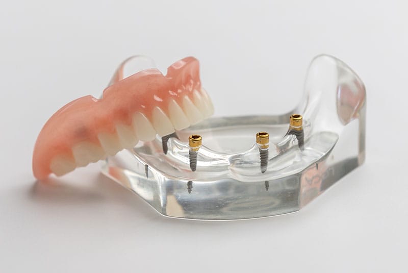 Implant Stabilized Overdentures Implant Stabilized Overdentures