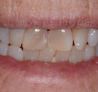 Dental Implants Before