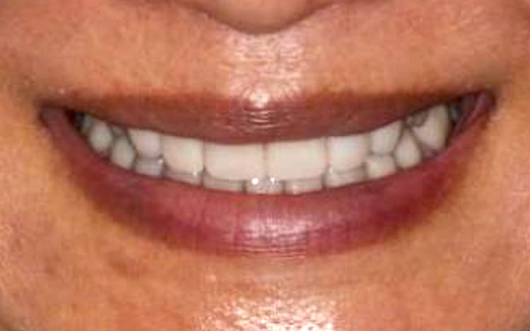 23. Patient LL (14 teeth)_ 6 porcelain crowns on upper front teeth and 11 porcelain crowns on lower teeth After