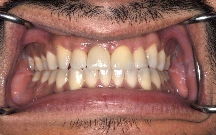 8. Patient J.D_ 2 porcelain crowns for smaller peg lateral teeth, implant front tooth with custom tissue shaping and porcelain implant crown, and front tooth porcelain veneer After