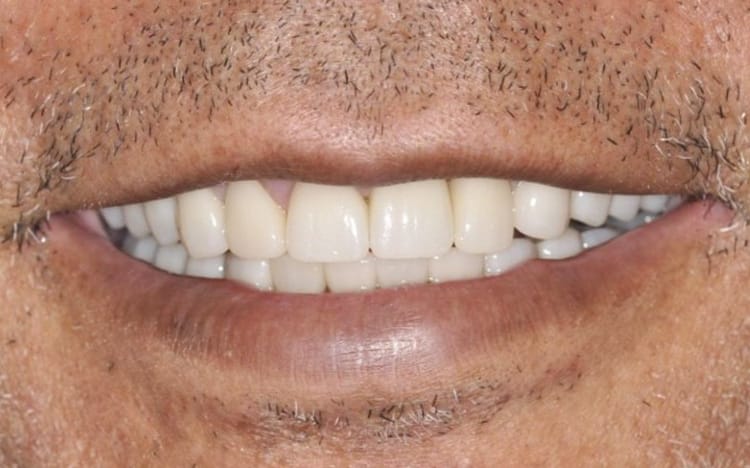 28. Patient GD (26 teeth + 2 implants - one implant is a front tooth!)_ 13 upper teeth with one front tooth porcelain implant crown and 13 lower porcelain crowns After