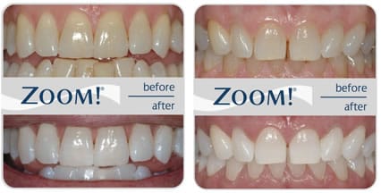 Zoom teeth
