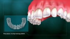 Clear Aligner Technology (Impression) 002