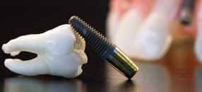 Dental implants